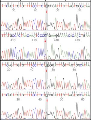 A case of chorea-acanthocytosis with significant improvement of symptoms at one year with deep brain stimulation: case report and literature review